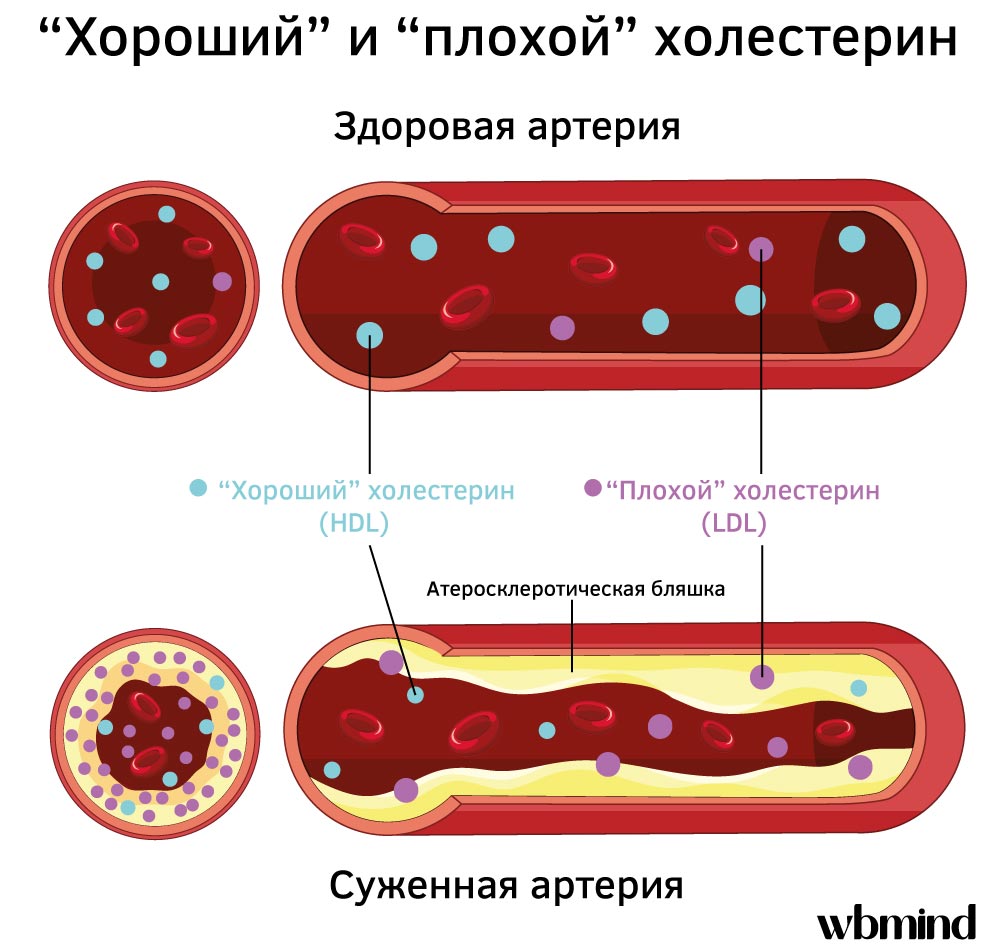 Хороший и плохой холестерин