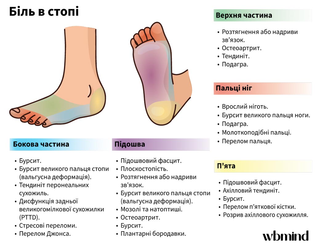 Біль в стопах: причини